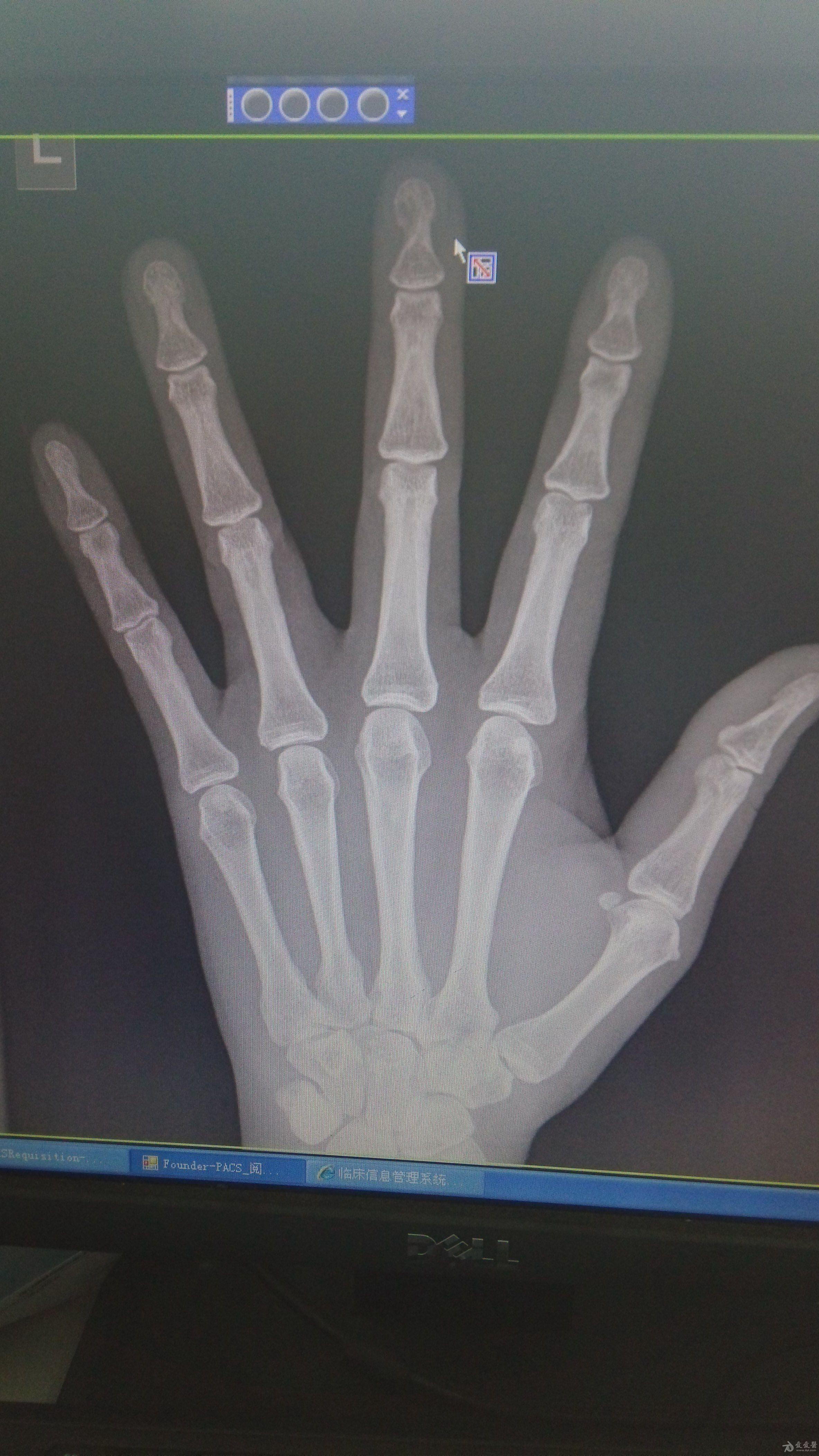 左手中指疼痛原因待查