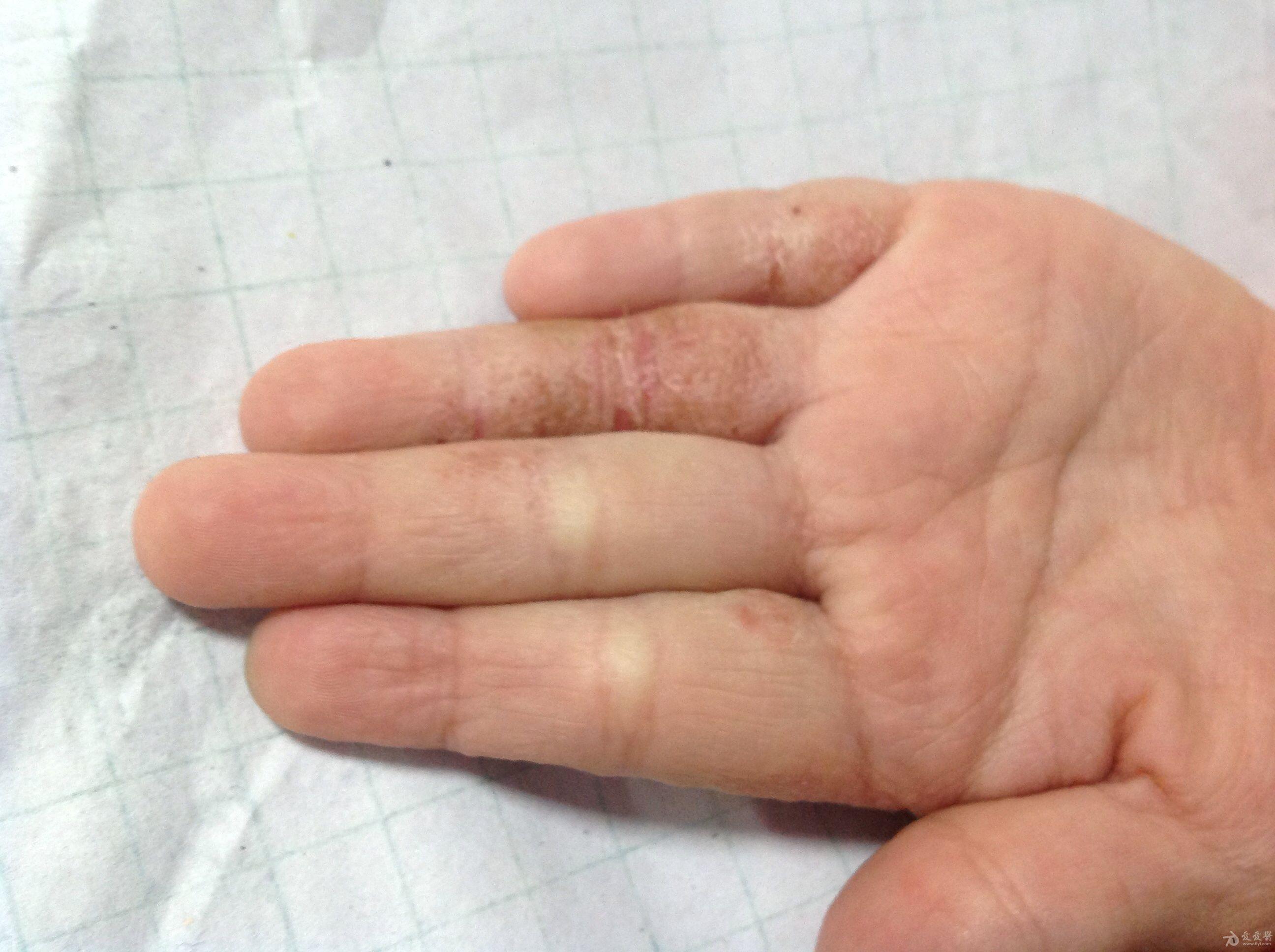 小儿手部顽固皮肤病.