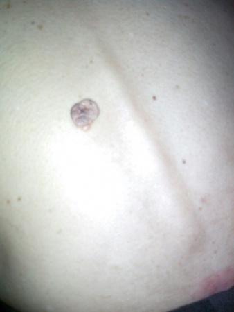 快来看看,这个痣会是恶性的吗