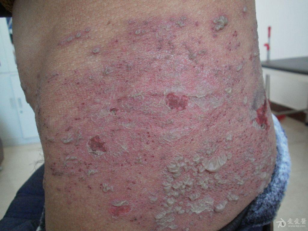 皮肤及性传播疾病讨论版 - 爱爱医医学论坛 - 爱爱医医学网