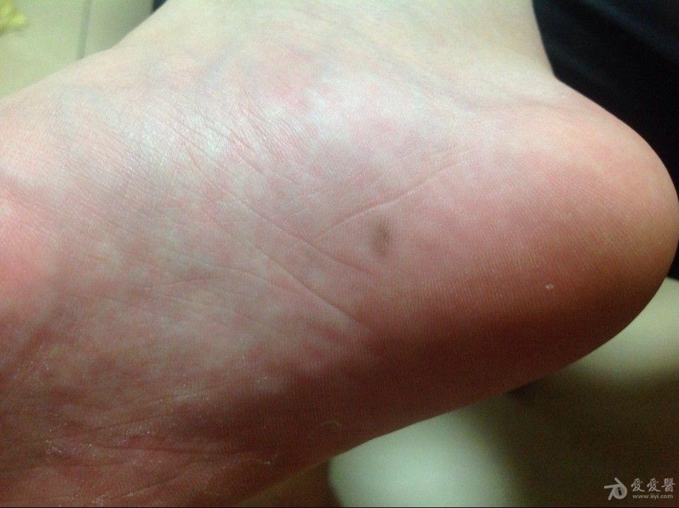 请看图:脚底出现类圆形深褐色"痣"