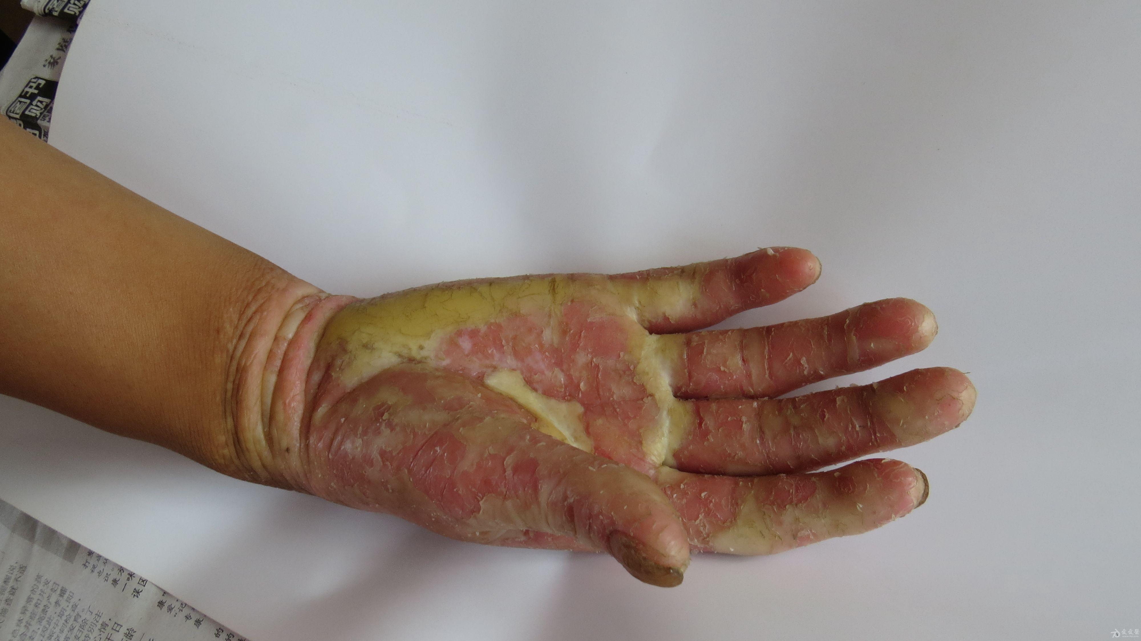 双侧口角,痒 ,身上其它处无,用珊瑚癣净泡后,脱皮,半月没事