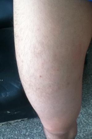 大腿撞伤肿痛,中份皮下有大片血肿