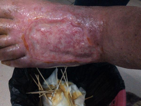 梅毒(阳性).请大家帮忙看一下怎么处理这样的难愈合的创口.