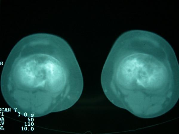 雙側膝關節疼痛,ct檢查
