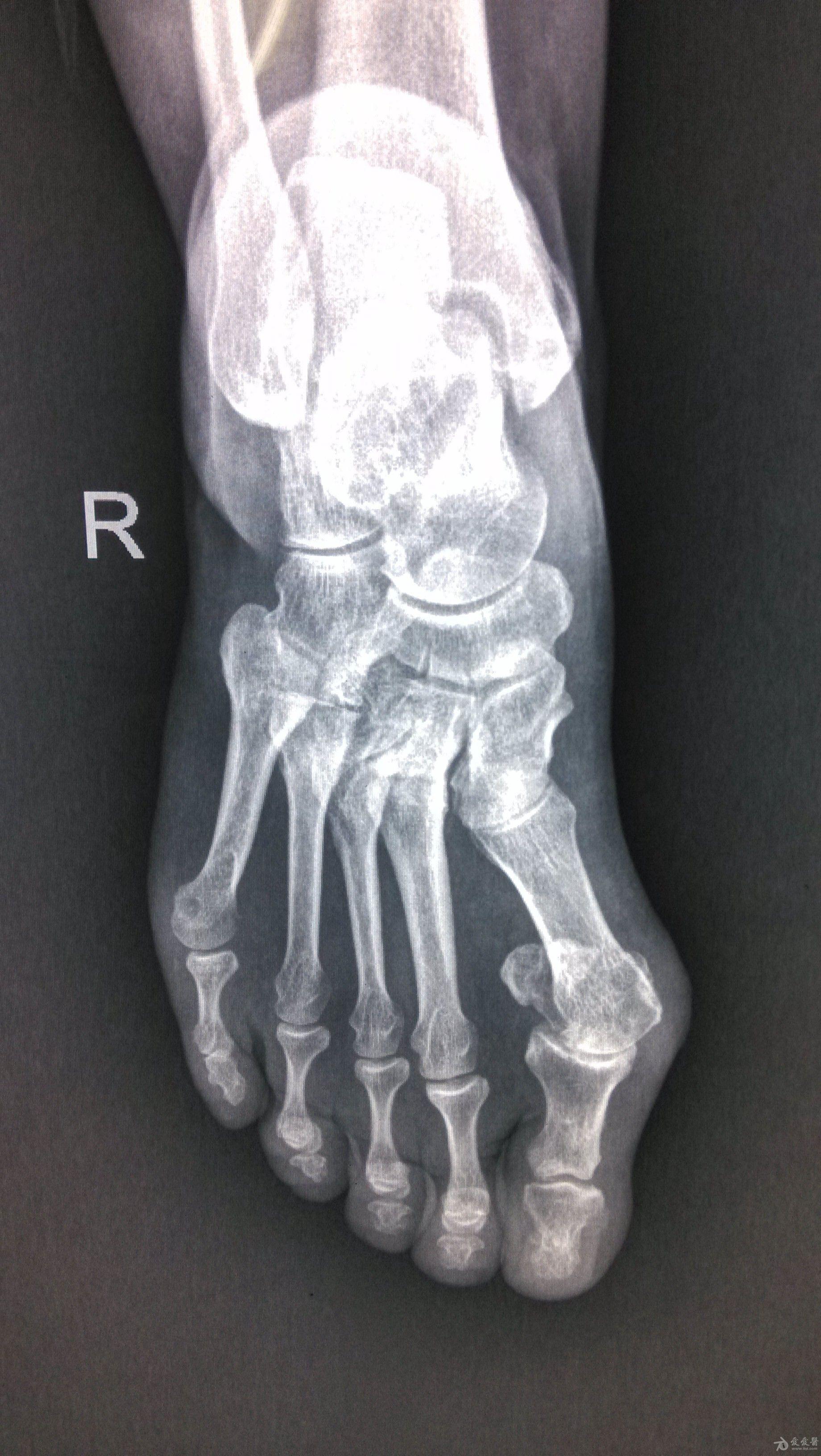 足部骨骼x光图片