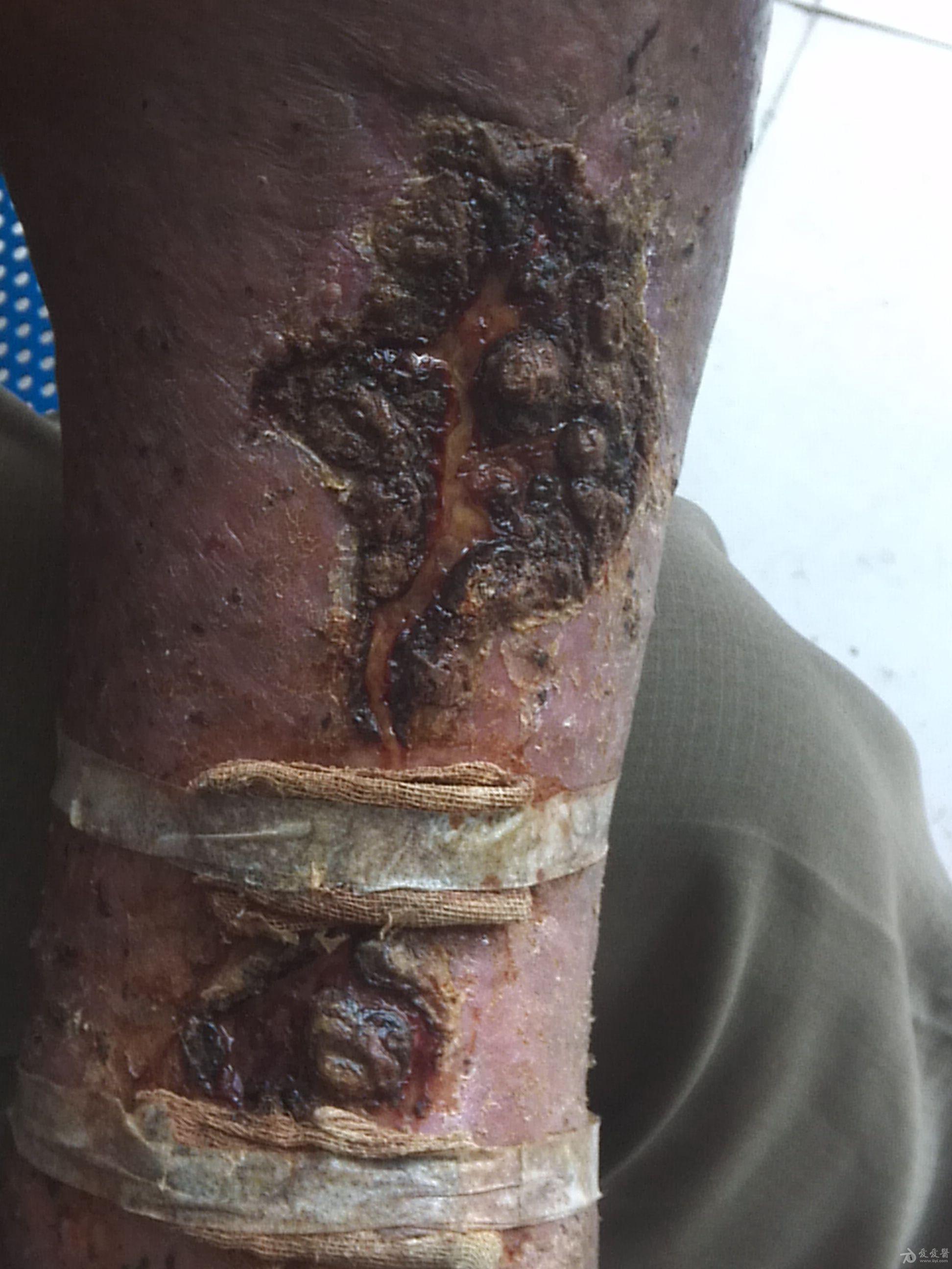 各位同仁帮看看这个是皮肤癌还是恶性溃疡 - 皮肤和性疾病资源版 - 爱