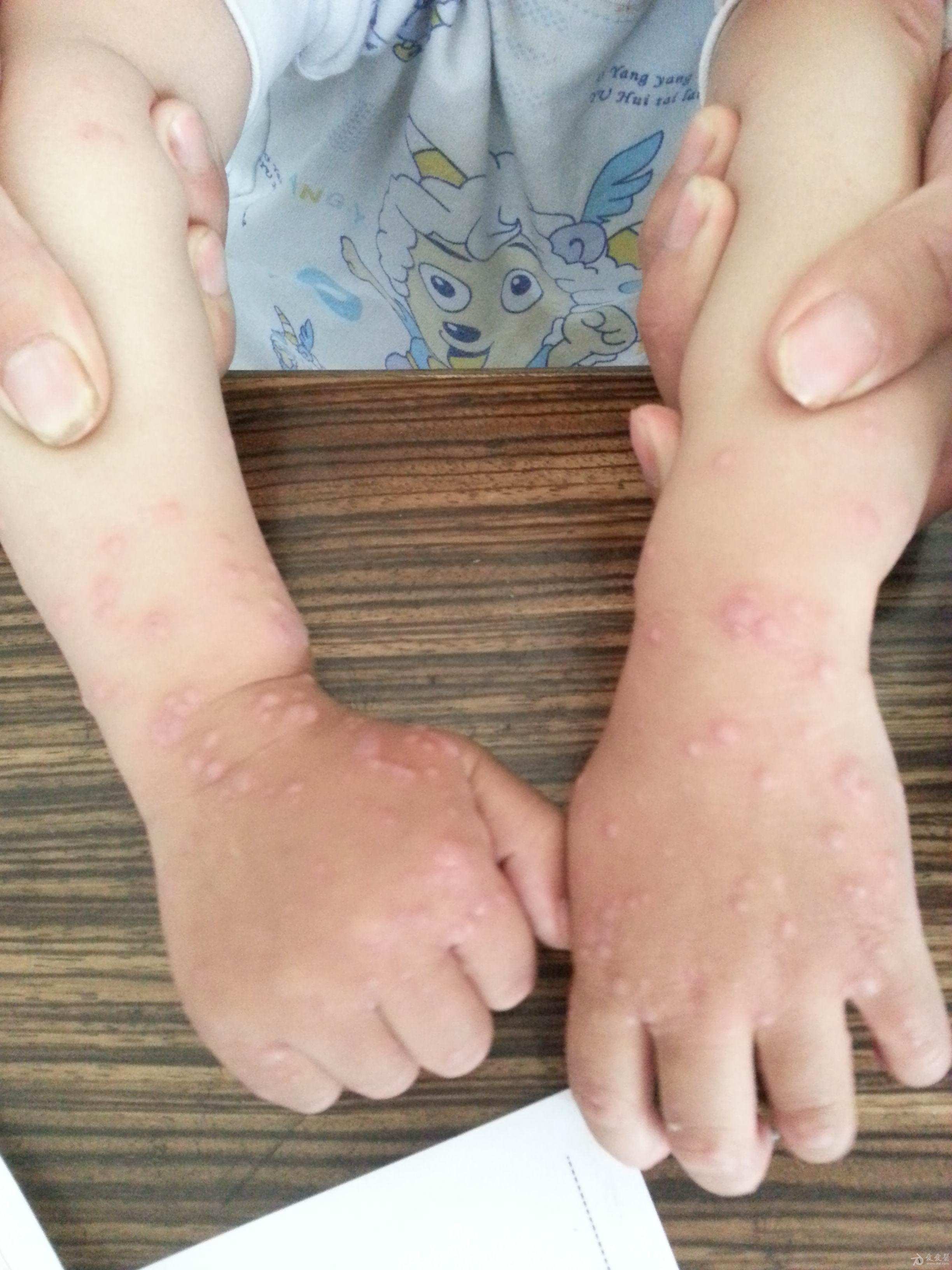 儿童皮炎早期症状图片图片