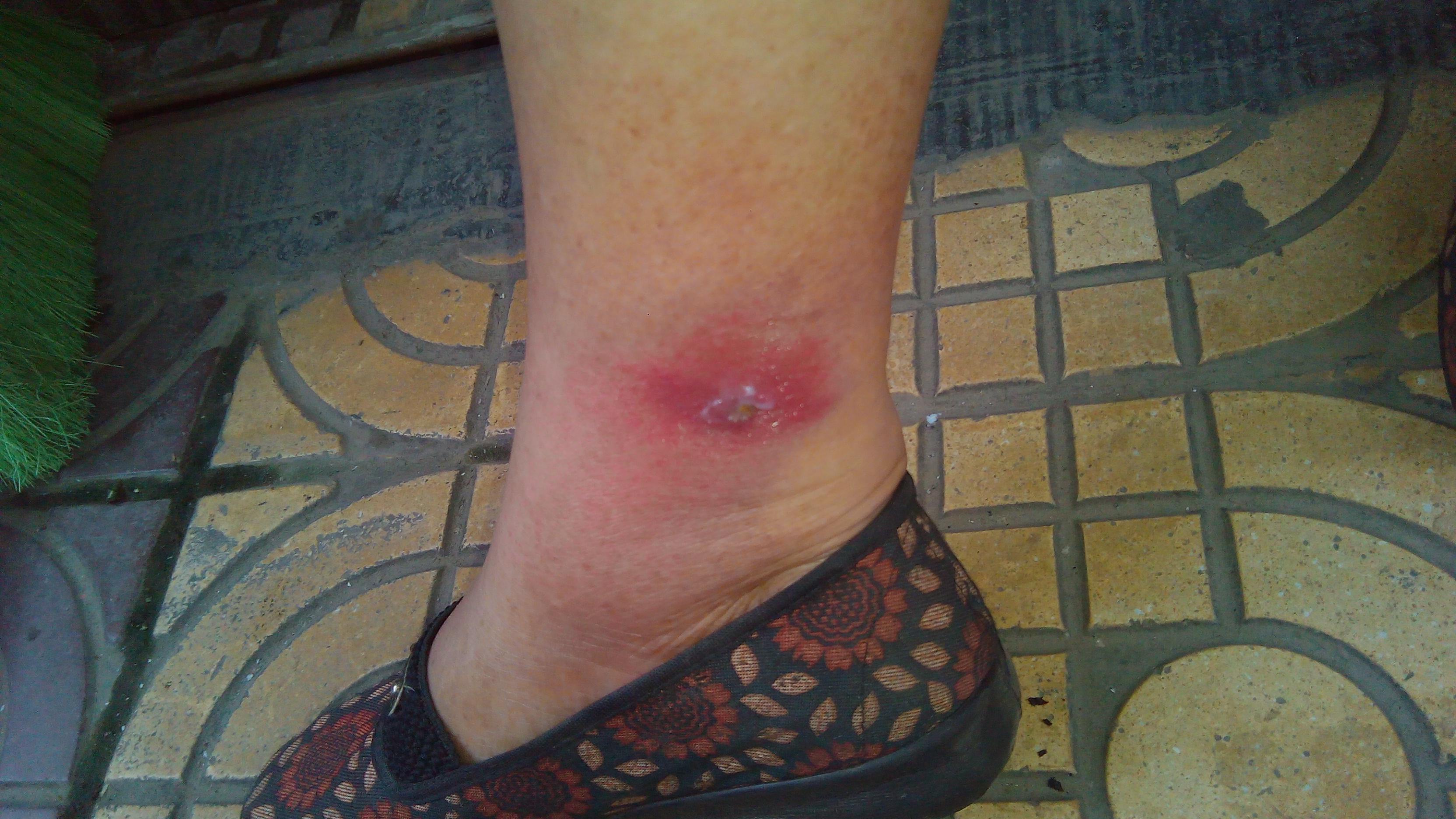 这是皮肤感染吗?