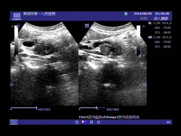 超声入门贴372-壶腹癌