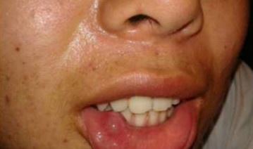 舌腹粘液腺囊肿图片