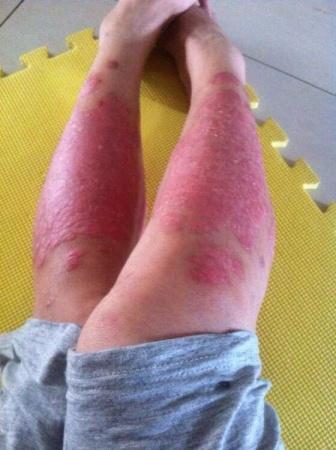 请问各位这个银屑病病例 是不是红皮型银屑病?