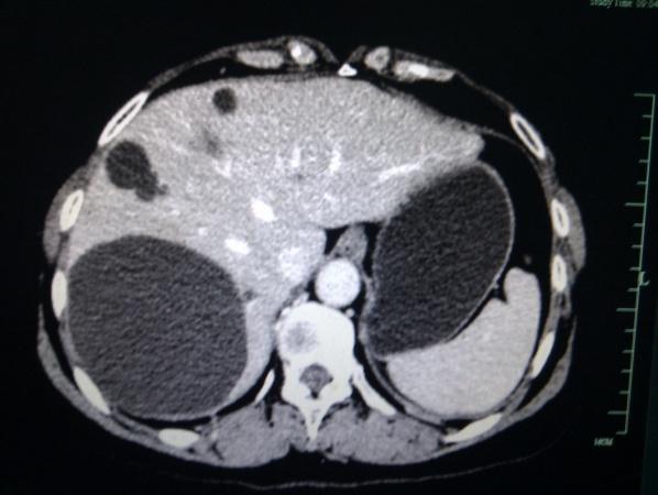 自发性双肾包膜下血肿,求原因