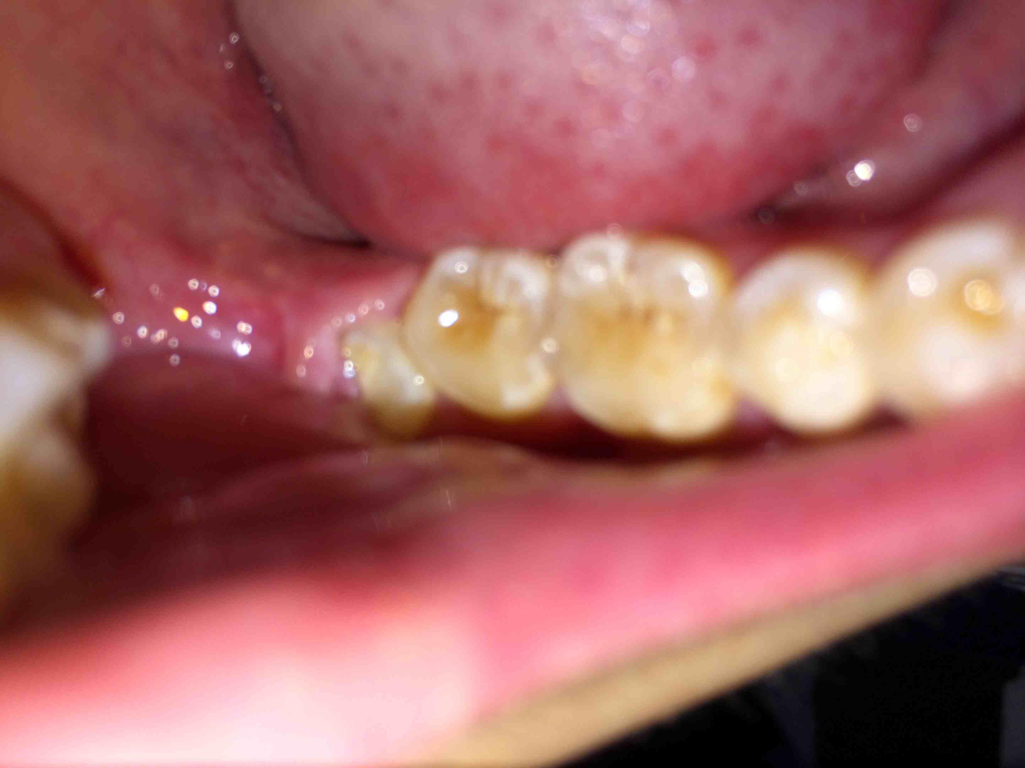 大牙根部牙龈肿痛图片图片