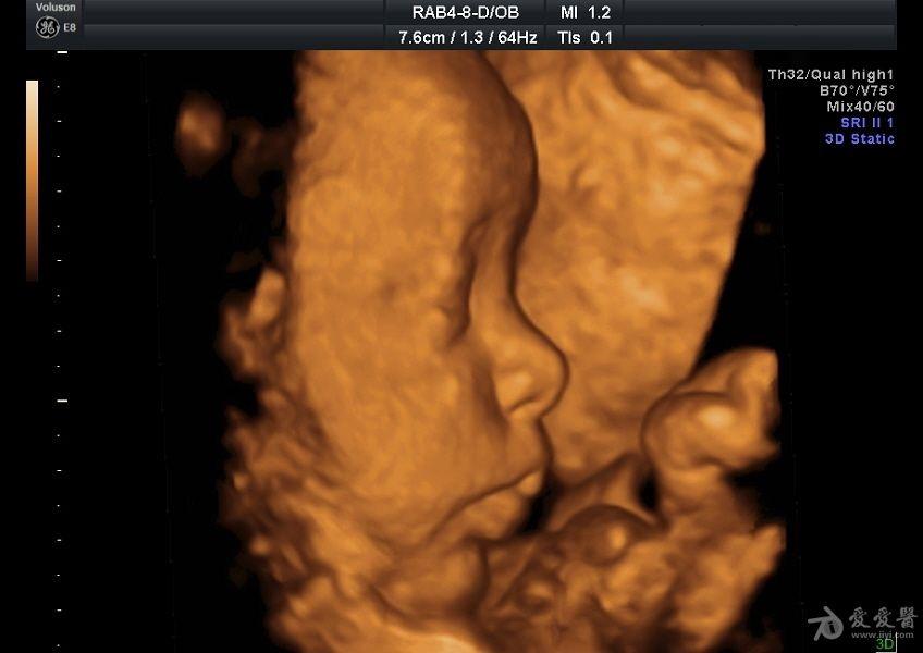 胎儿三维彩超图片好丑图片