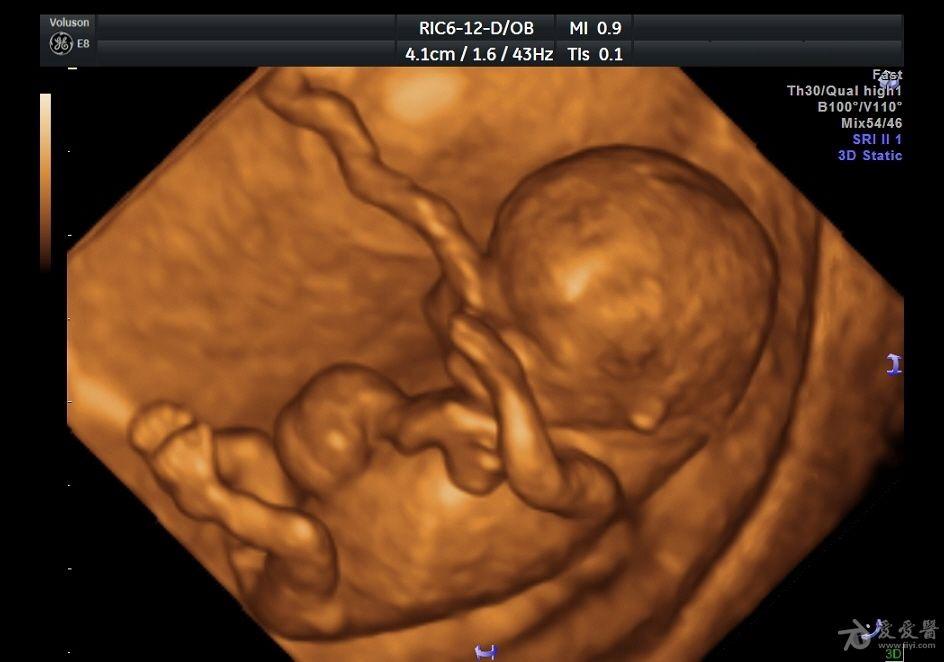 胎儿三维彩超图片好丑图片