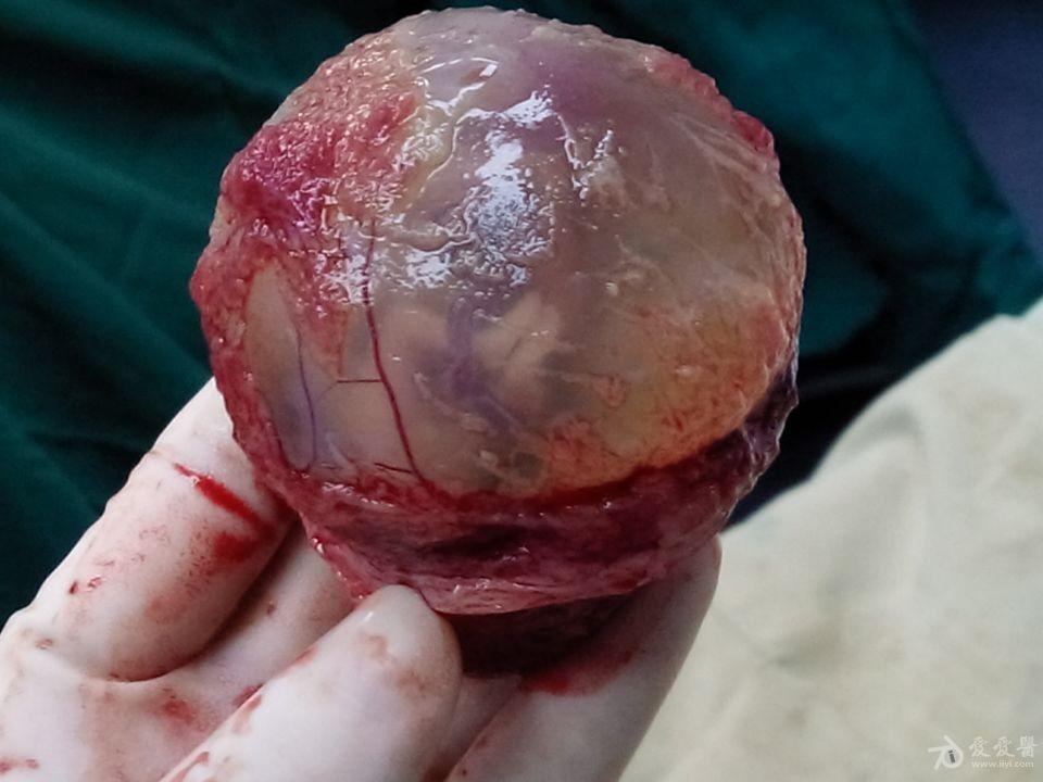 残角子宫妊娠一例(图)