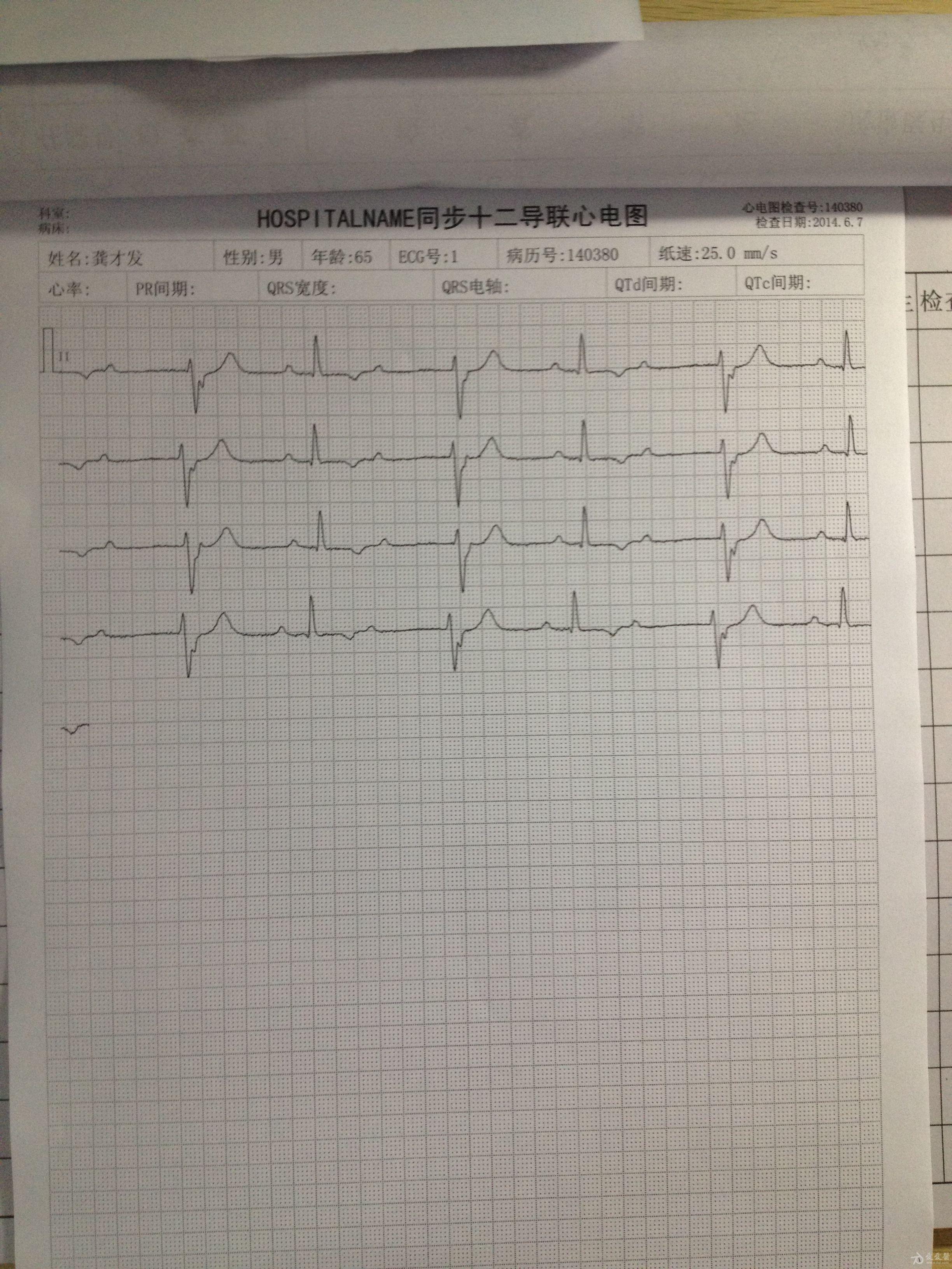 加速室性逸搏,二度二型窦房传导阻滞?