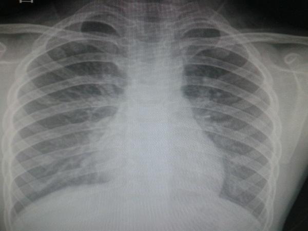 轻度肺炎胸片图片