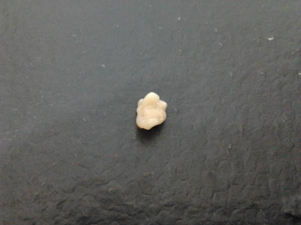 21:37:37咽部(大概是扁桃体的后面和下面)反复出现白色小块状异物