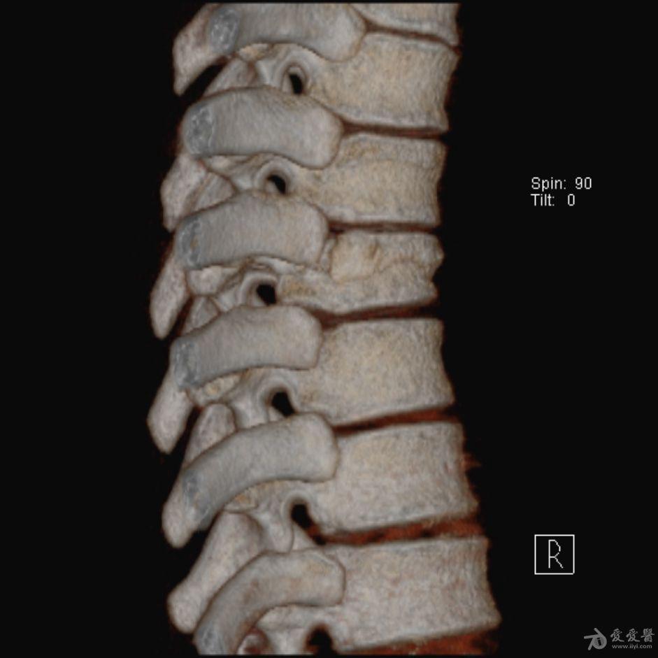 22:43:44chance 骨折胸腰段椎體的分離性骨折,伴隨脊髓,神經根,椎體的