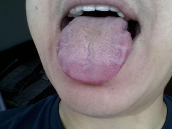 8,体检有右肾结石,轻度脂肪肝.