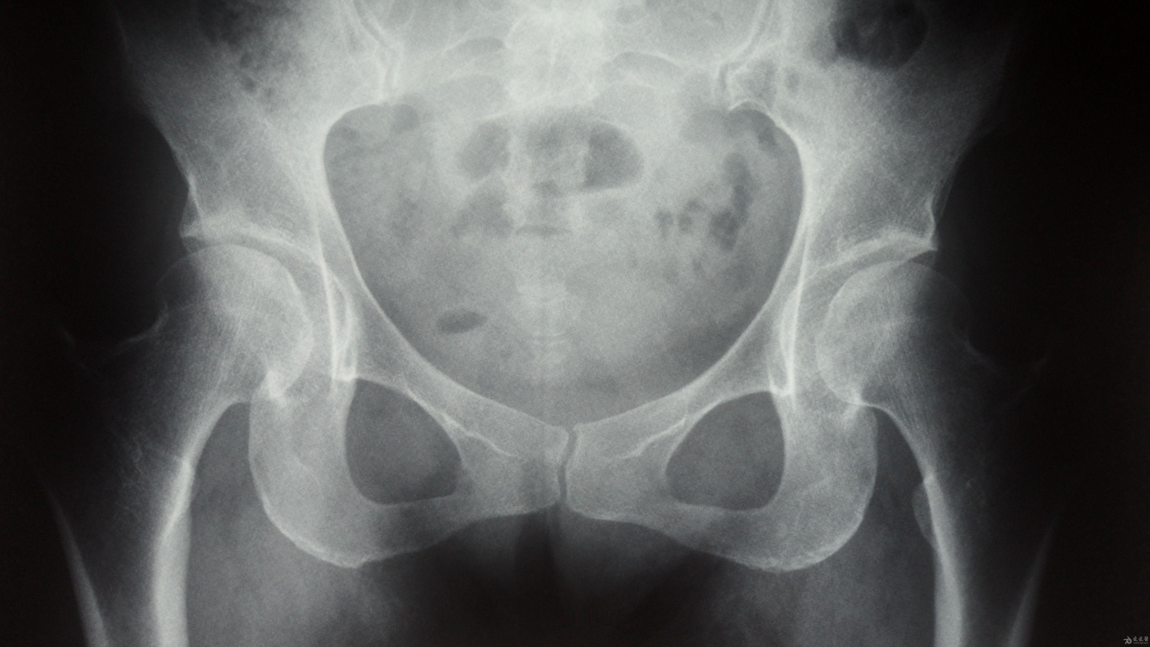后腹股沟,臀部,及大腿外侧疼痛加剧,于去年10月份核磁示双侧髋关节