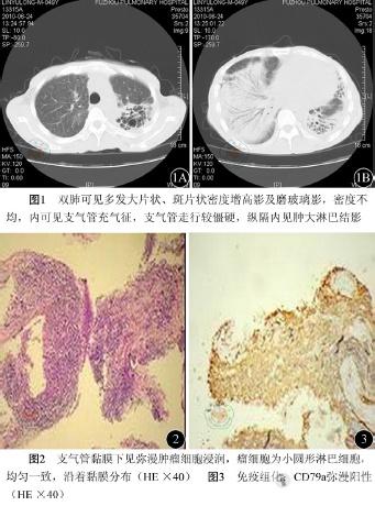 肺黏膜相关性淋巴瘤误诊为继发性肺结核一例