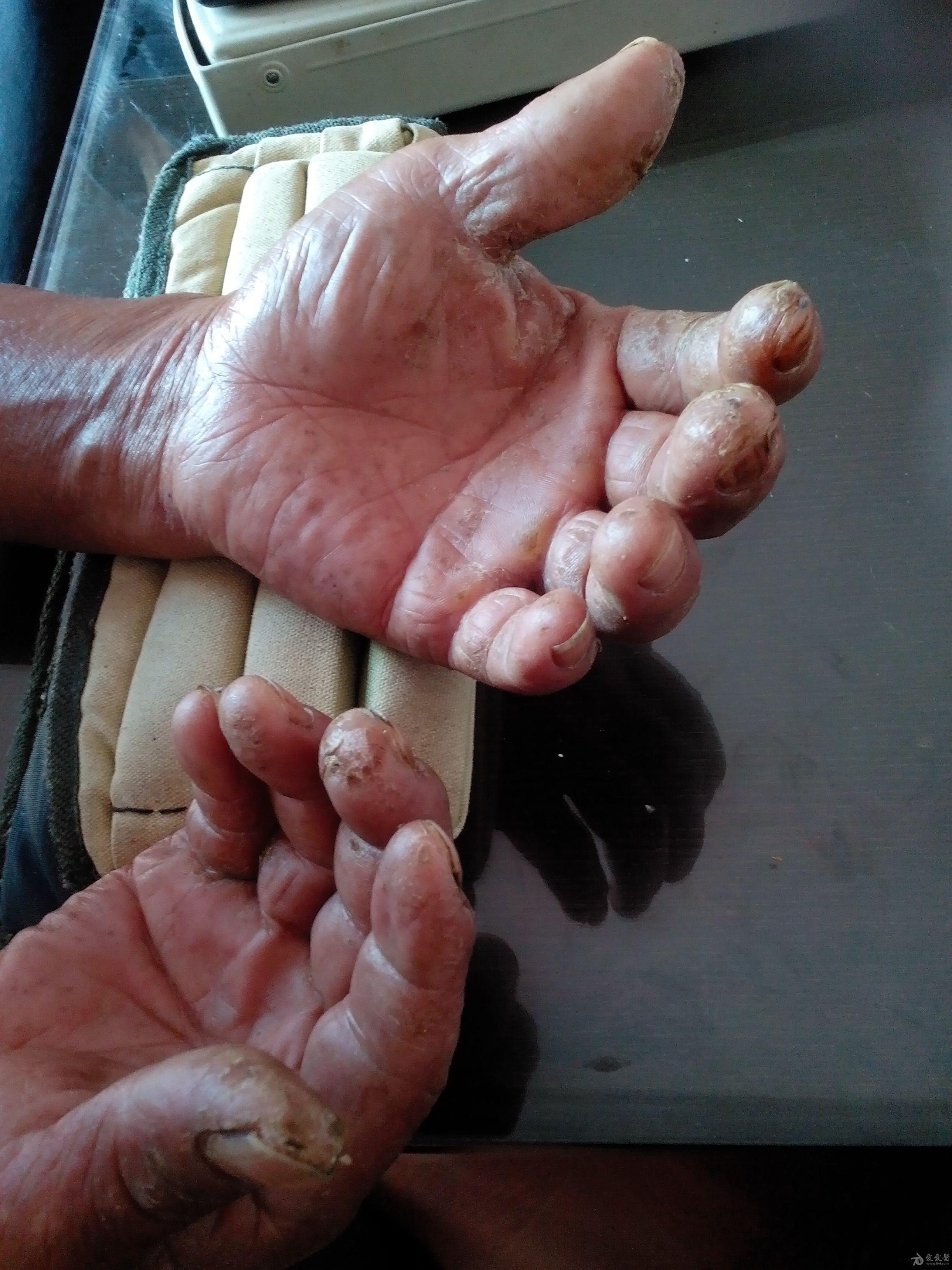 反复双手手指皲裂,搔痒10年