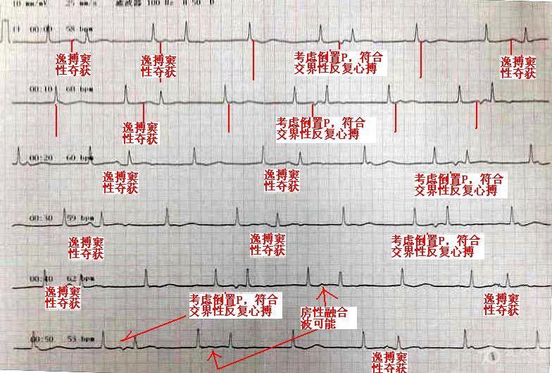 p波高尖心电图诊断图片
