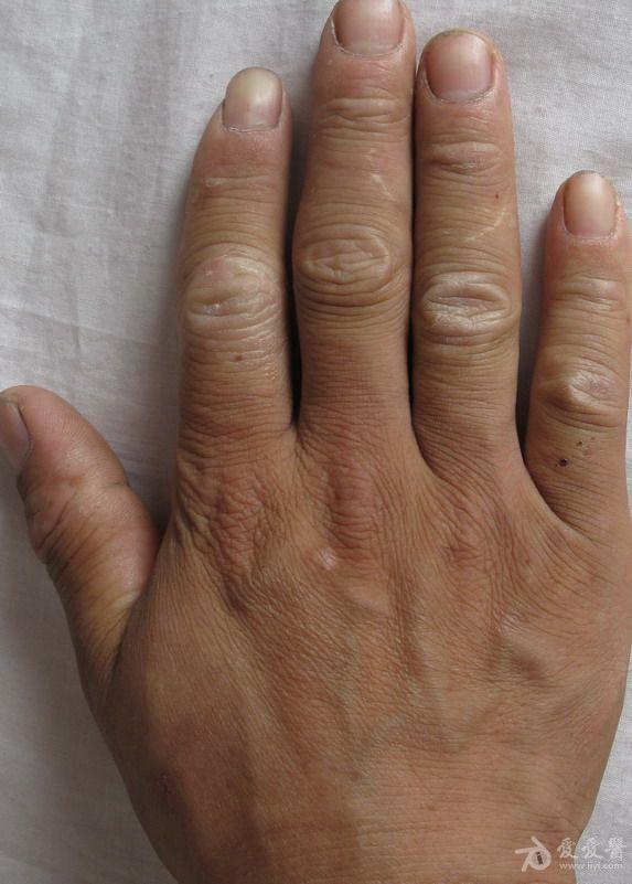 手指皮肤角化症角质图片