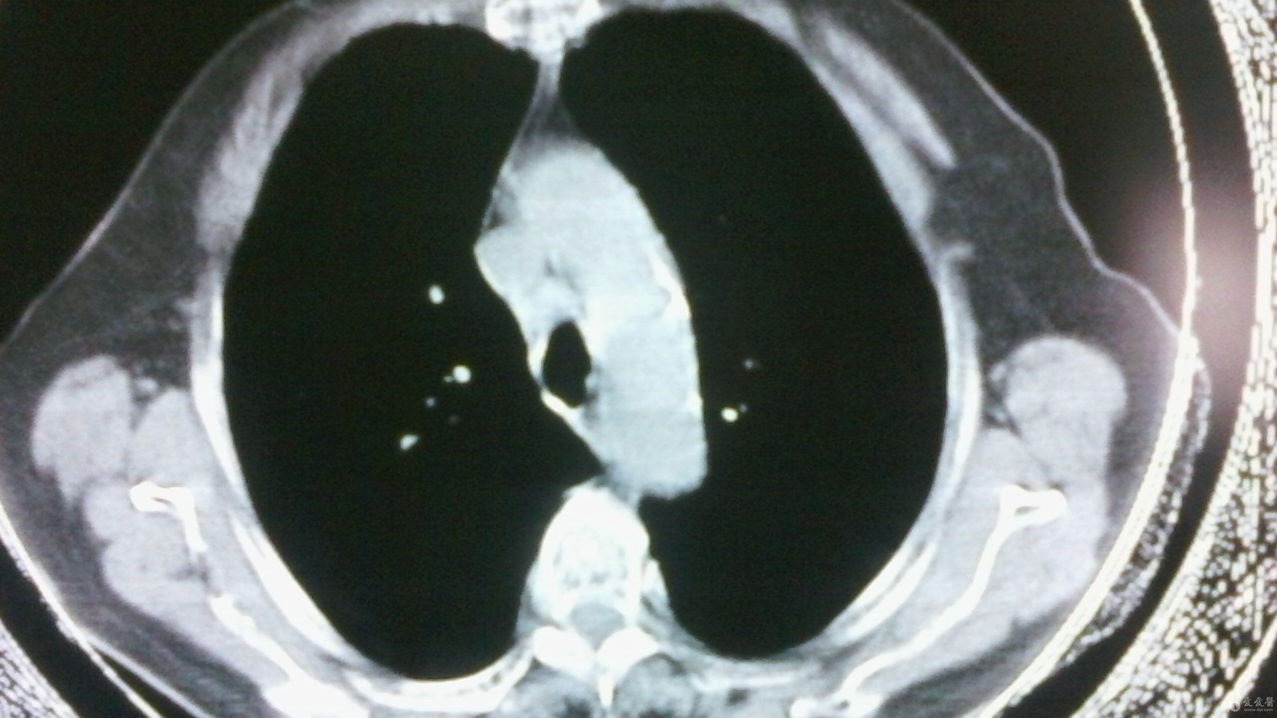 肺部ct一例 医学影像学讨论版 爱爱医医学论坛 爱爱医医学网