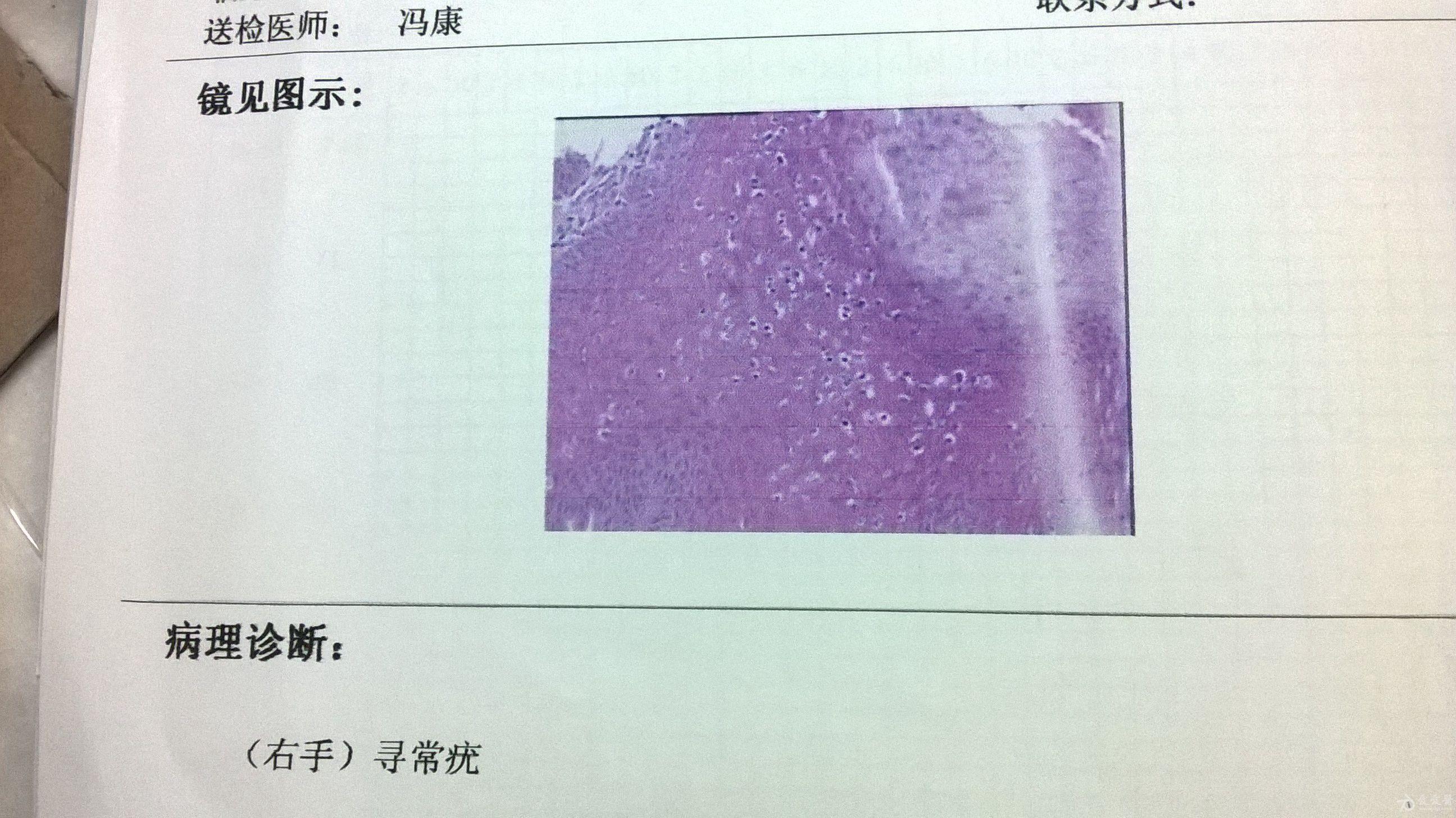 求寻常疣具体治疗方案