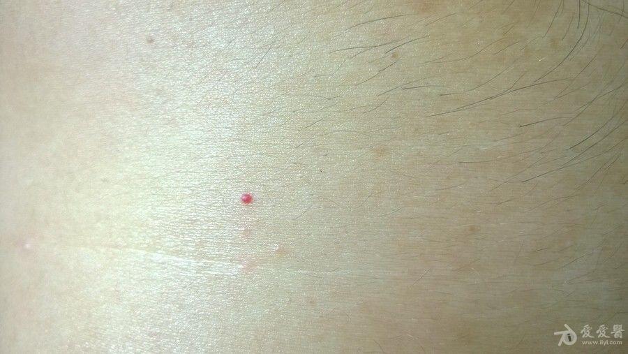 皮肤上有小红点像血点图片