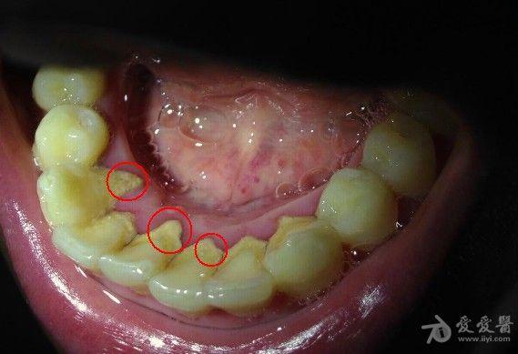 有图,下面门牙周围牙龈白色的