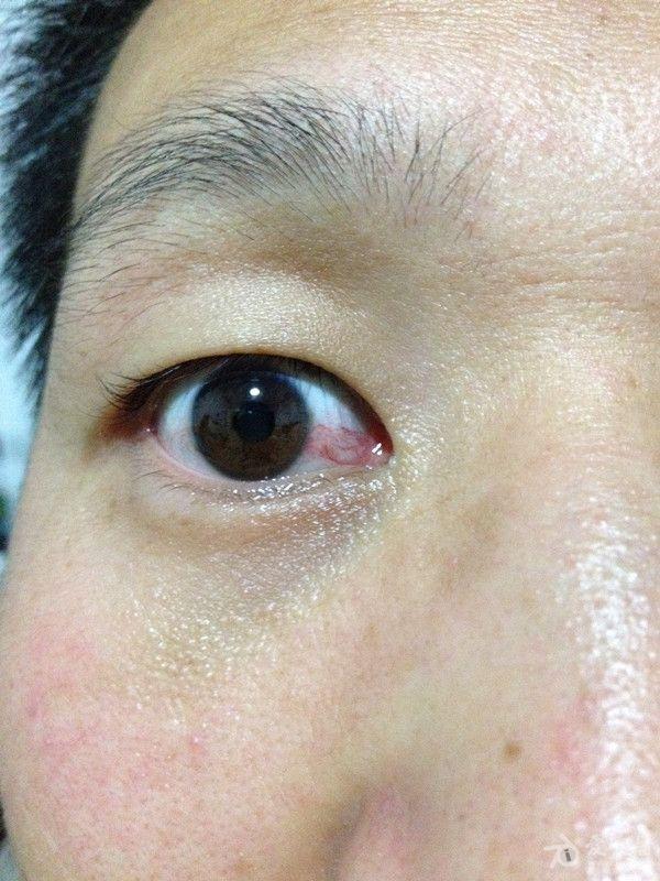 肝癌眼睛红血丝的图片图片