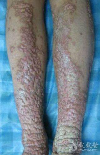 白色丘疹性大疱性表皮松解症