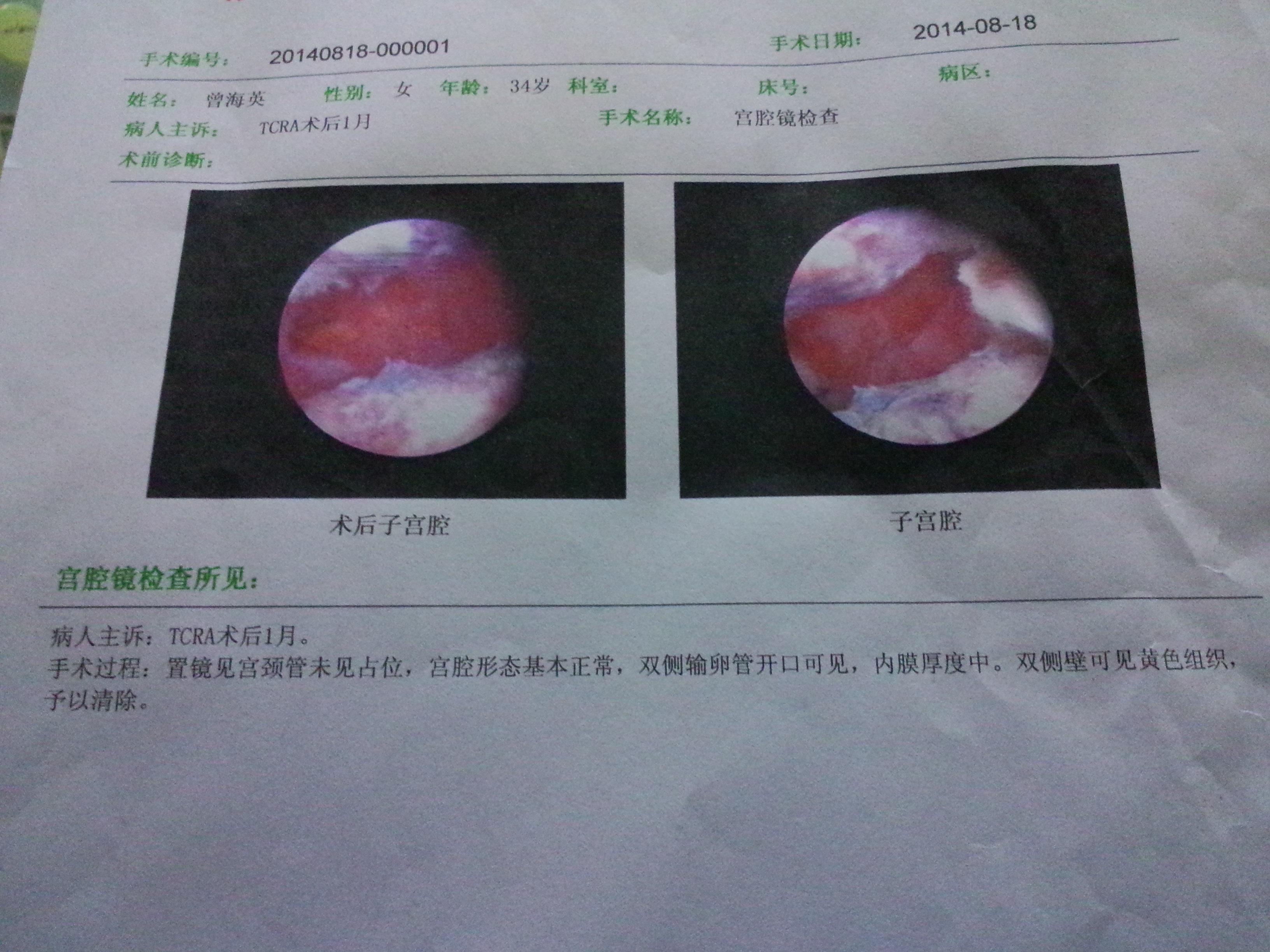 宮腔鏡醫保報銷比例 深圳宮腔鏡手術社保報銷嗎