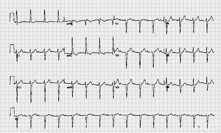 左前分支阻滞心电图图片
