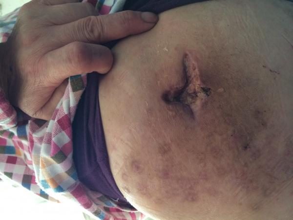 女性左侧臀部无菌性坏死