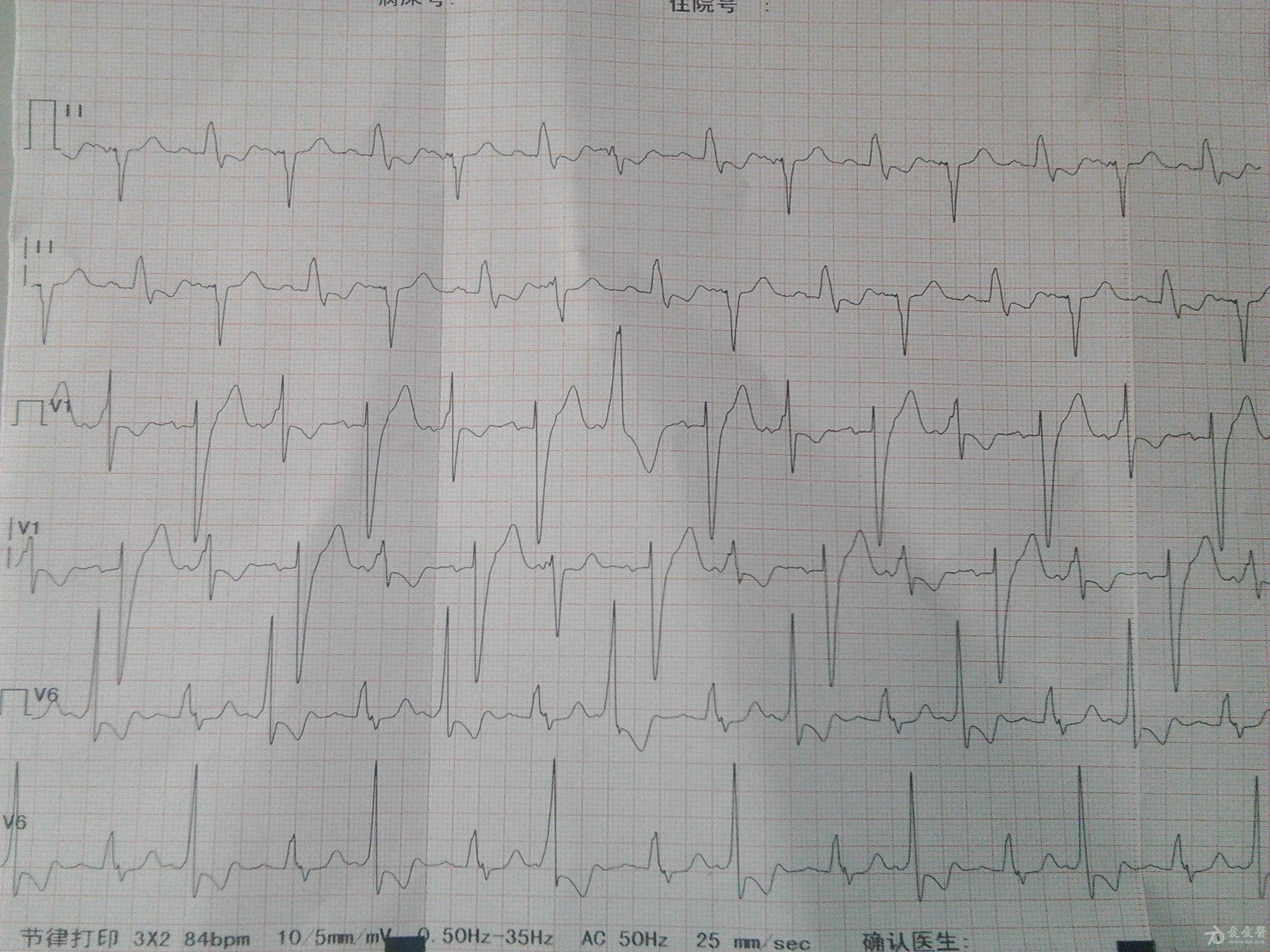 扩张性心脏病的心电图,大家看看
