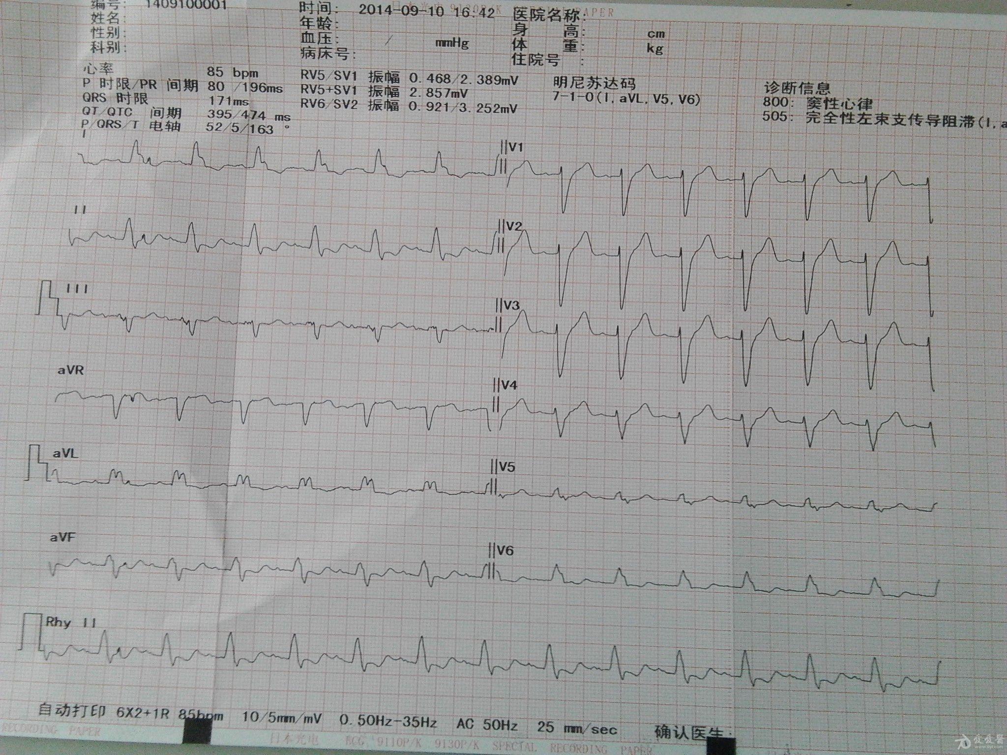 扩张性心脏病的心电图,大家看看