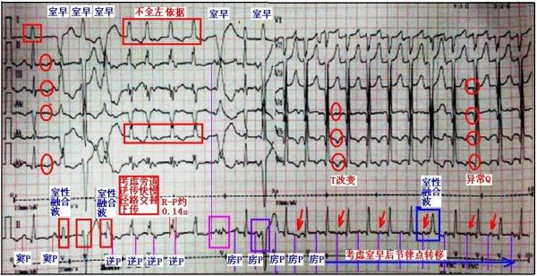 疑難心電圖大家看?
