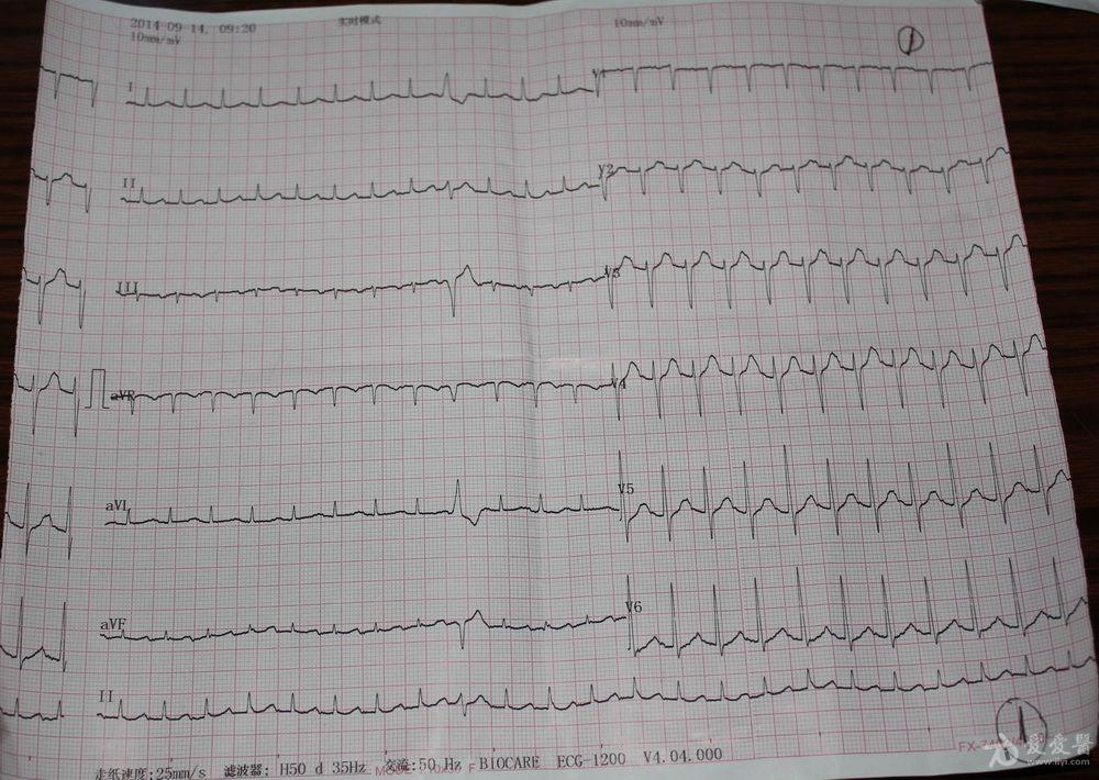 樓主ba19na72na2小時前 圖一為門診病人,自述心悸,請教心電圖診斷竇速