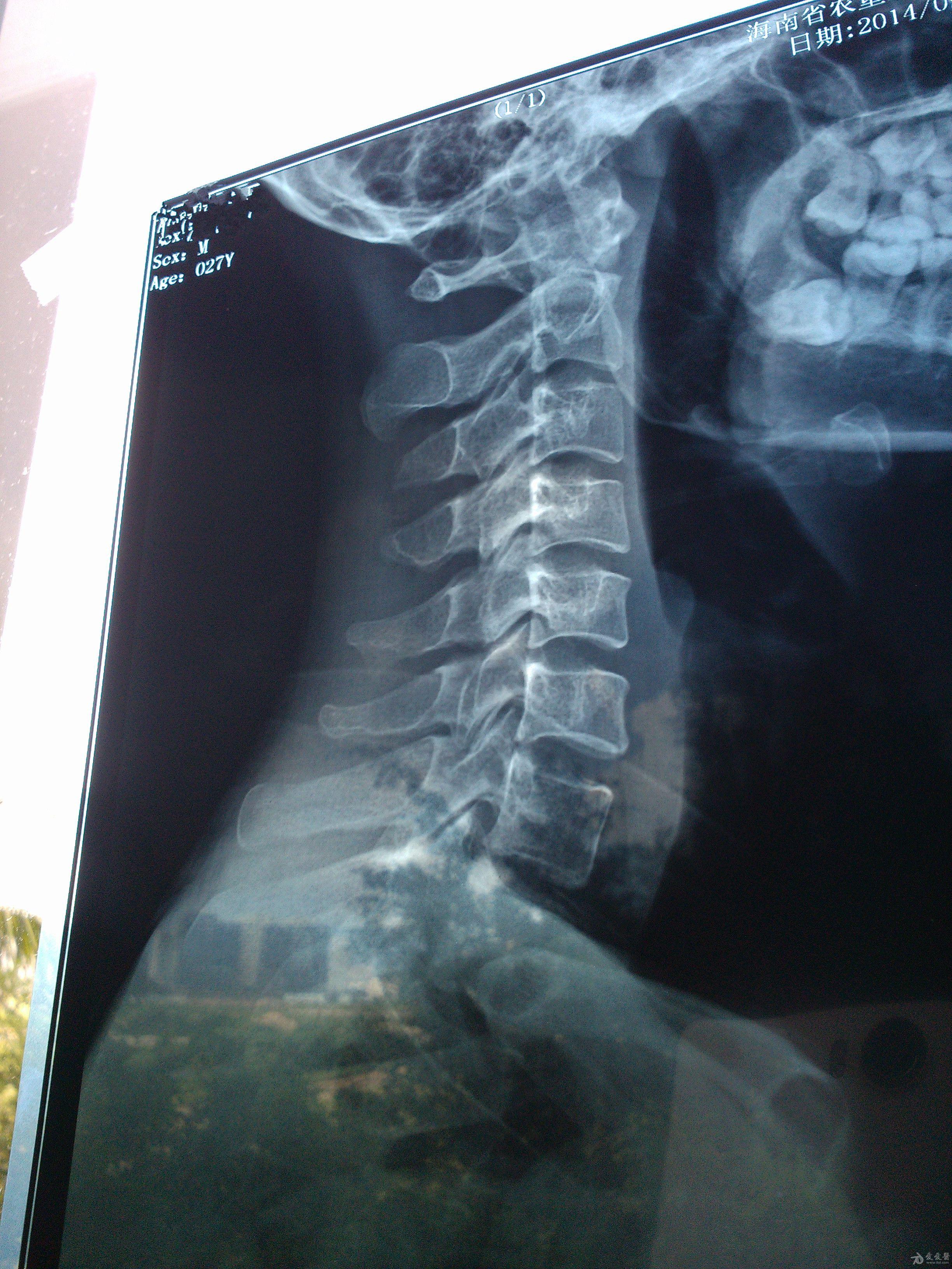 颈椎x光片 突出图片