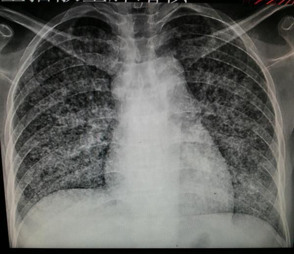 肺结核胸片阳性图片