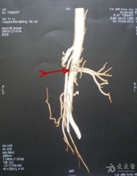 肠系膜上动脉压迫综合征(良性十二指肠瘀滞症)