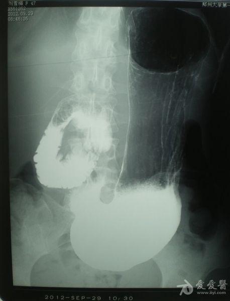 肠系膜上动脉压迫综合征(良性十二指肠瘀滞症)