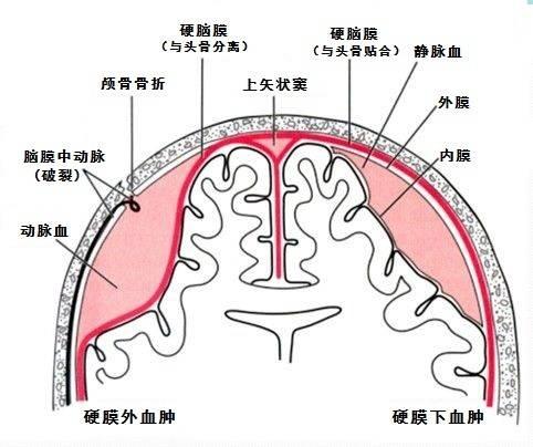 硬膜外,下血肿鉴别!