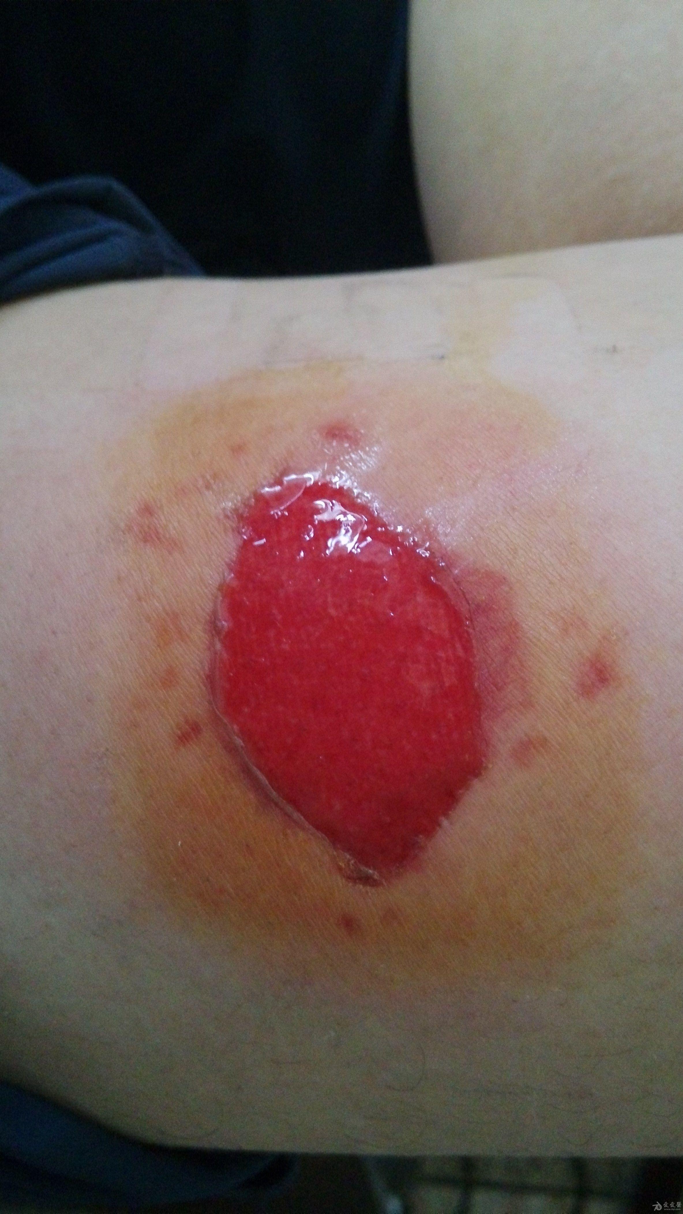 斑蝥粉引起的伤口,求助意见.